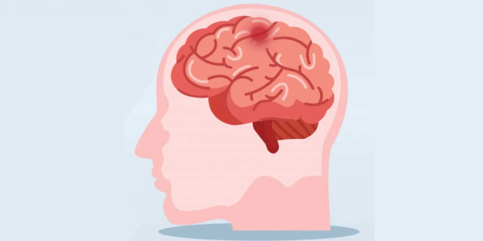 Oral direct Factor Xa inhibitors seem to override existing anticoagulants in treating stroke